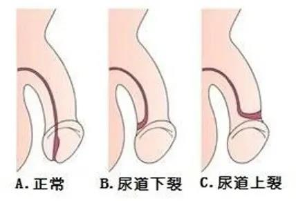 尿道口