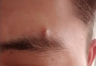 眉毛长痘痘